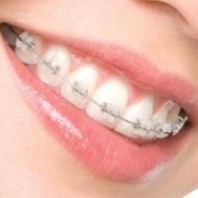 aparat dentar ceramic1